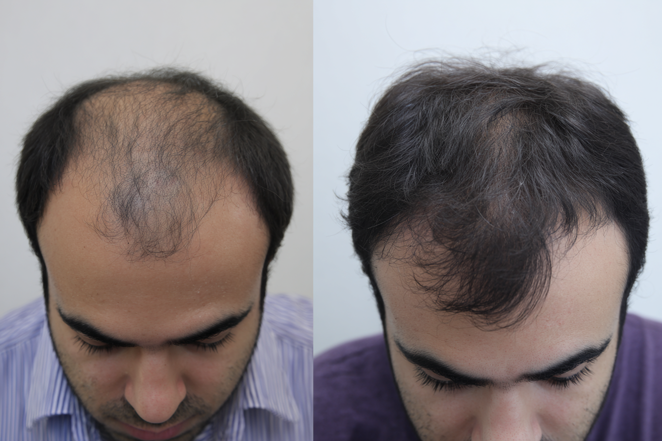Antes e Depois